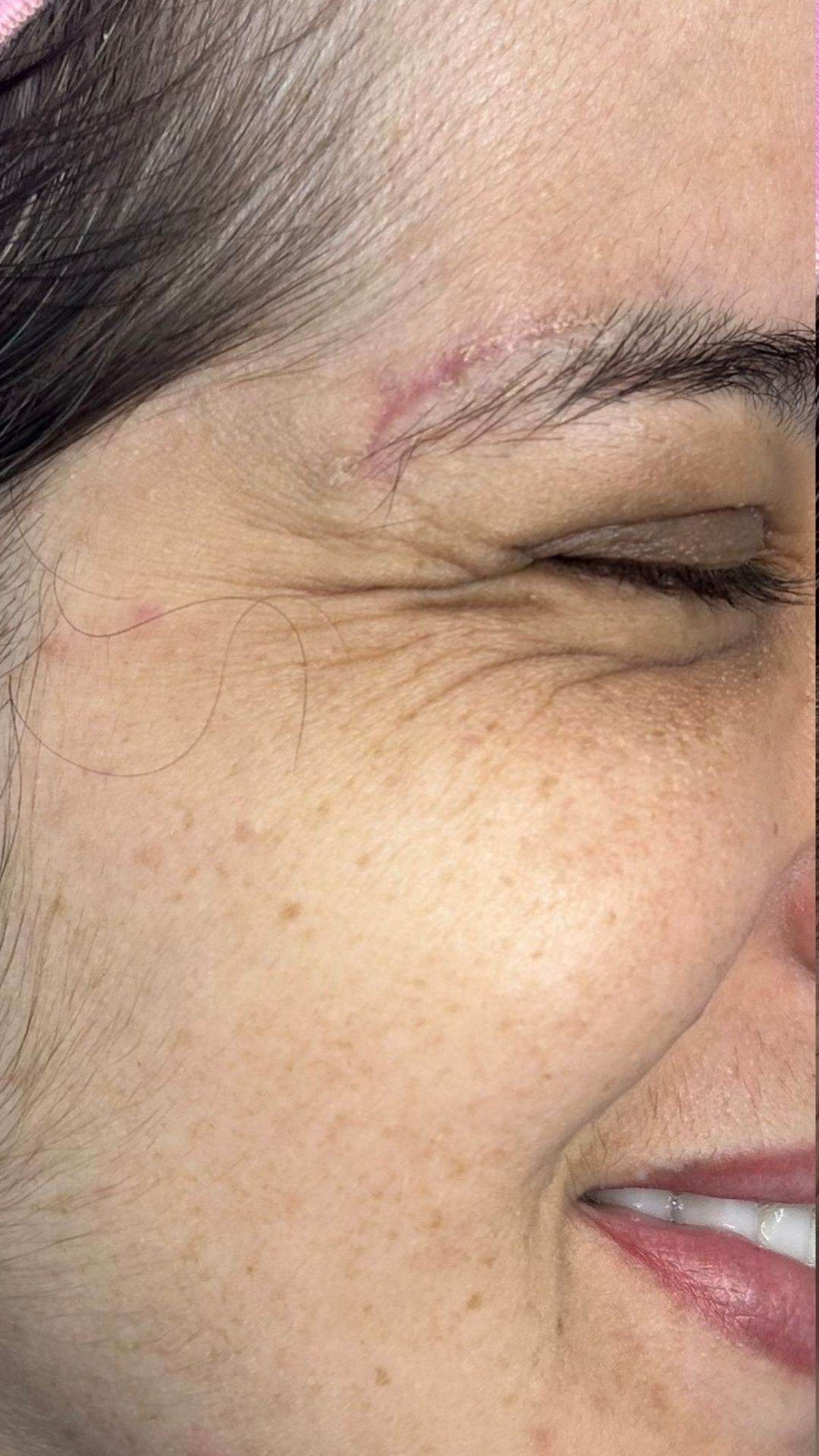 BOTOX BOTOX