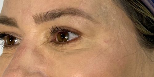 BOTOX (2) BOTOX (2)