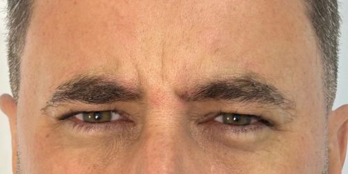 BOTOX (3) BOTOX (3)