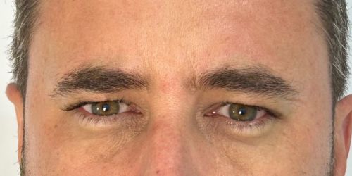 BOTOX (4) BOTOX (4)