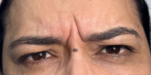 BOTOX (5) BOTOX (5)