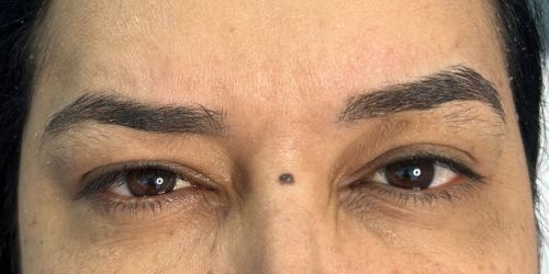BOTOX (6) BOTOX (6)