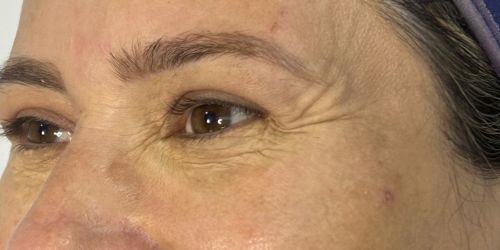 BOTOX BOTOX